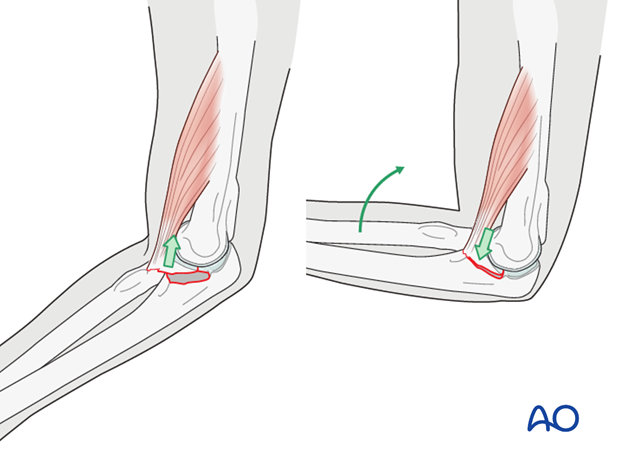 repair of coronoid fracture