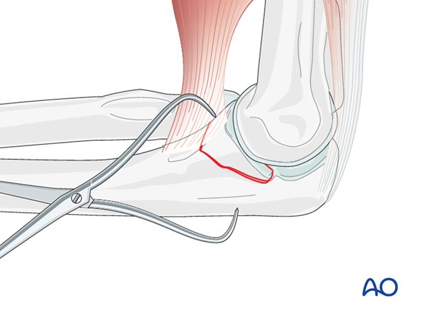 repair of coronoid fracture