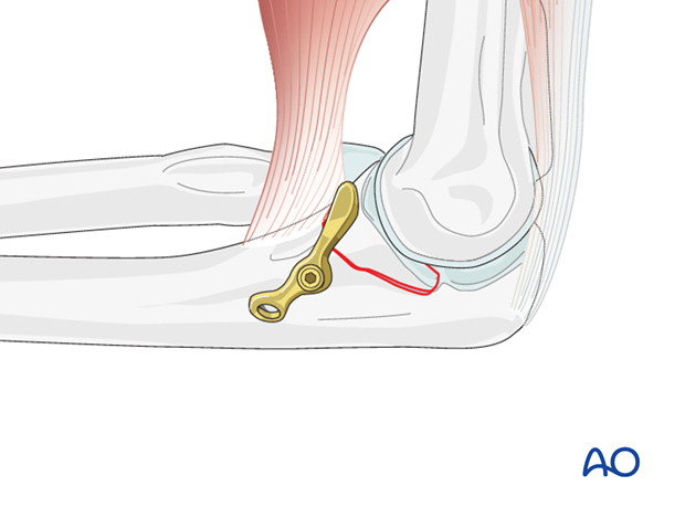 repair of coronoid fracture