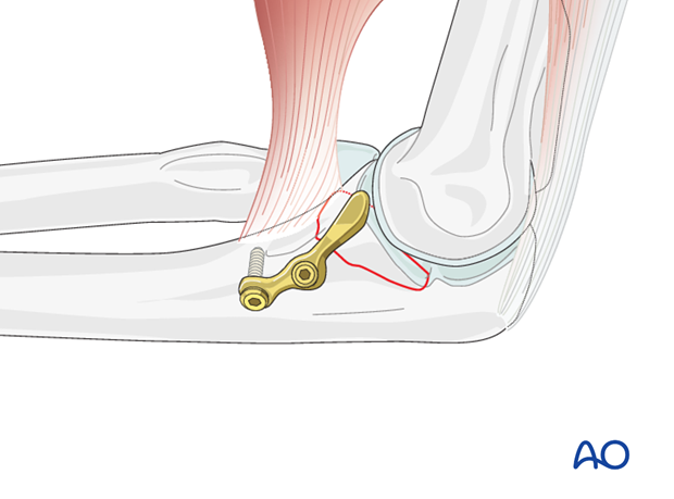 ulna articular coronoid