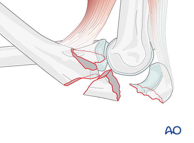 repair of coronoid fracture