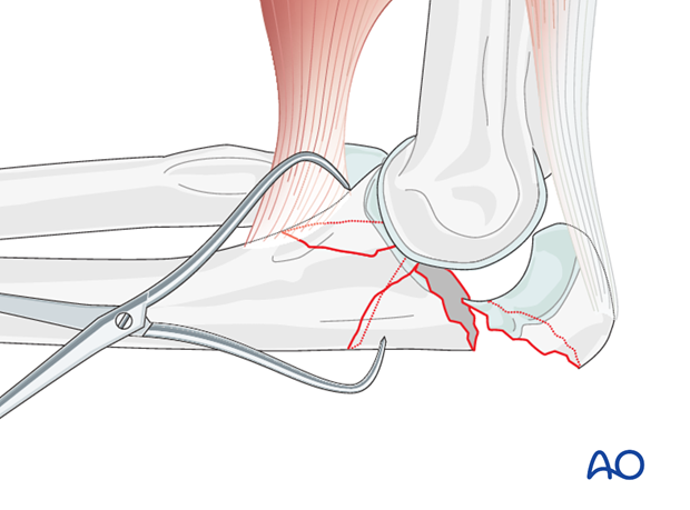 repair of coronoid fracture