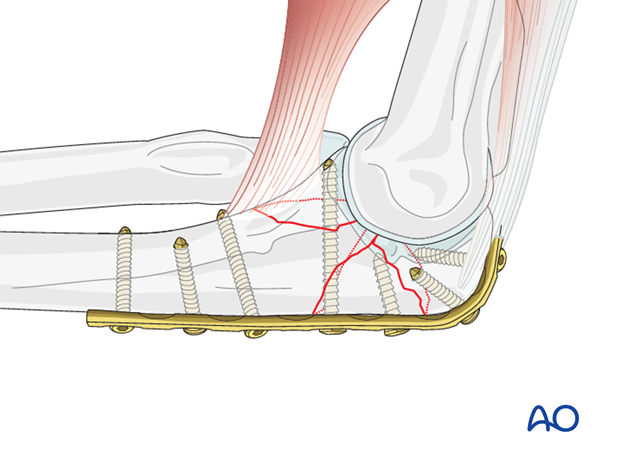 repair of coronoid fracture