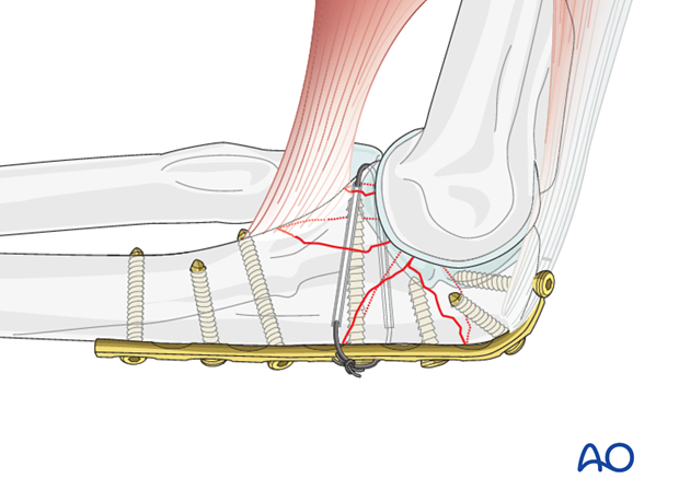 repair of coronoid fracture