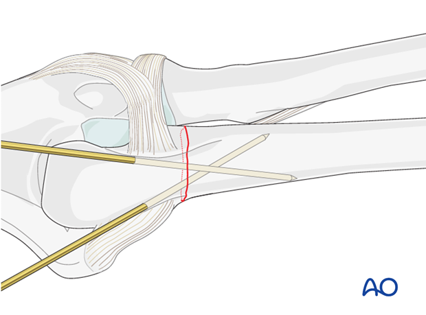 compression plate