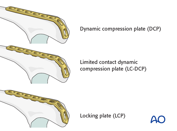 compression plate