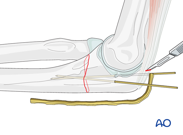 compression plate