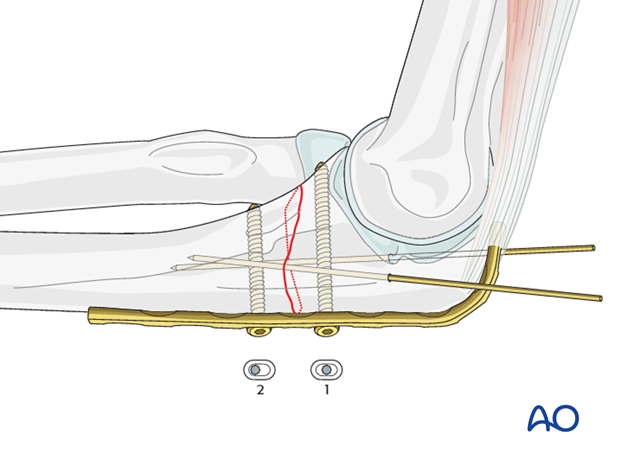 compression plate