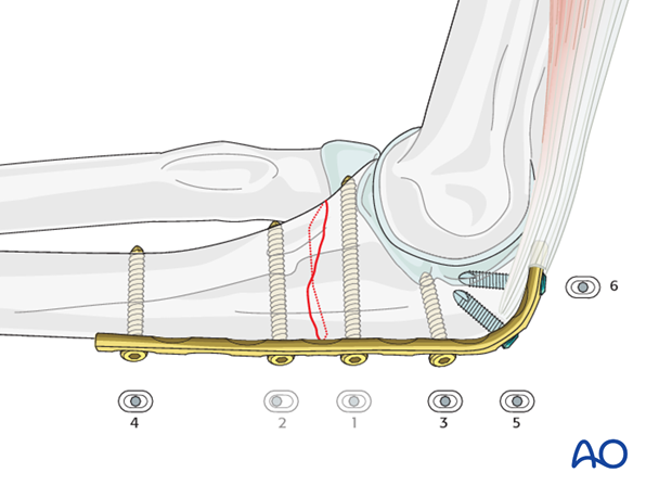 ulna extraarticular simple