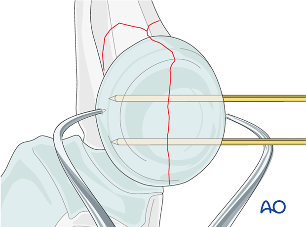 Complete radial head – Lag screw through plate - Reduction