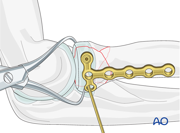 Complete radial head – Lag screw through plate – Temporary fixation