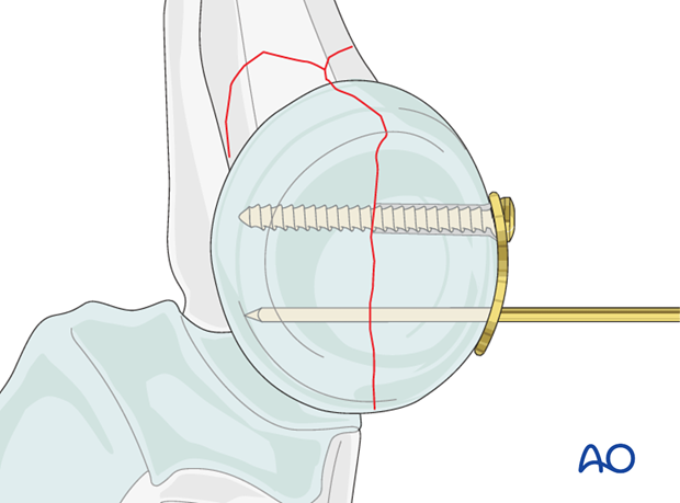 Complete radial head – Lag screw through plate insertion