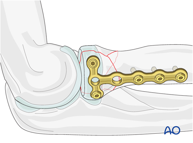 Complete radial head – Lag screw through plate fixation