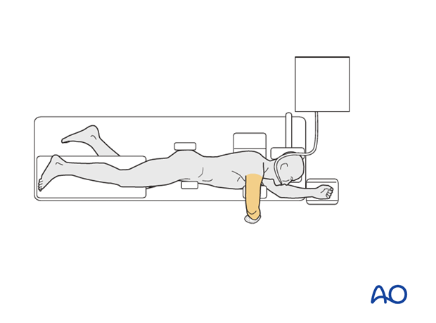 lateral decubitus position