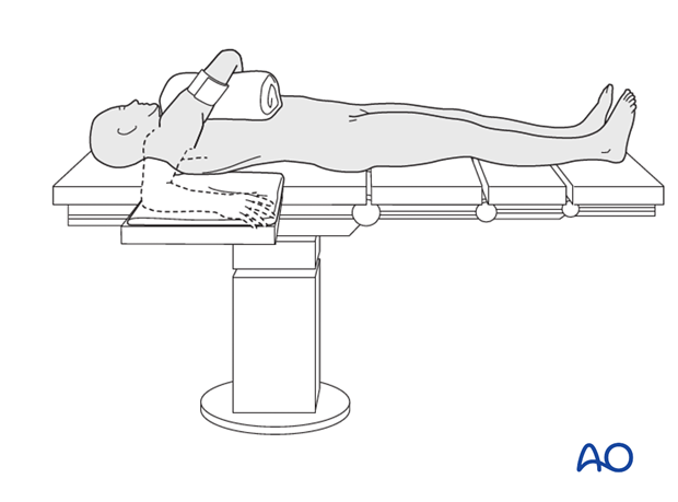 supine for lateral access