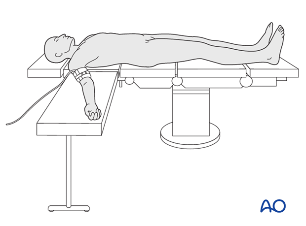 Supine for anterior access