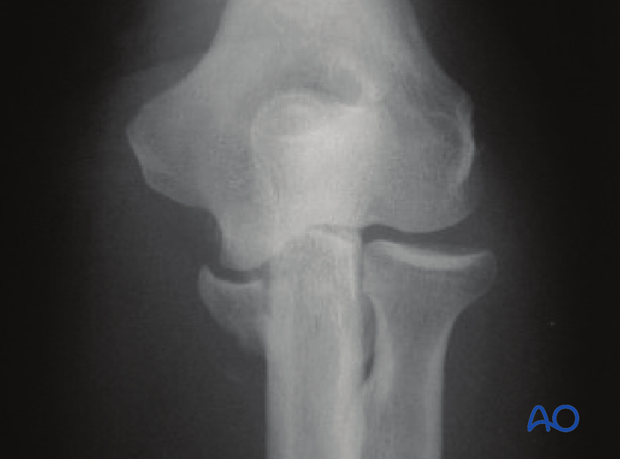 assessment of elbow stability