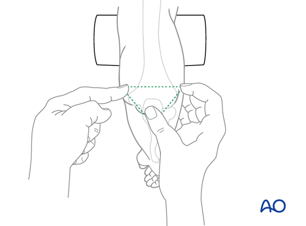 assessment of elbow stability