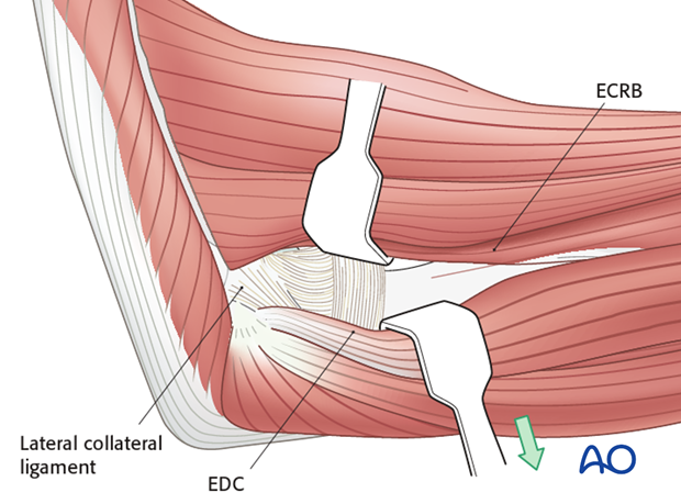 heterotopic ossification