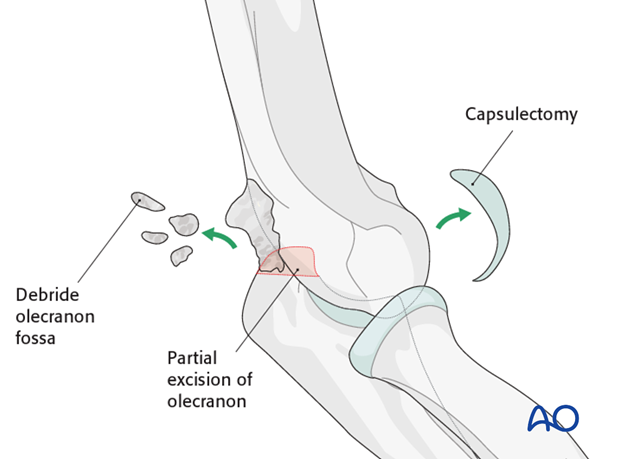 heterotopic ossification