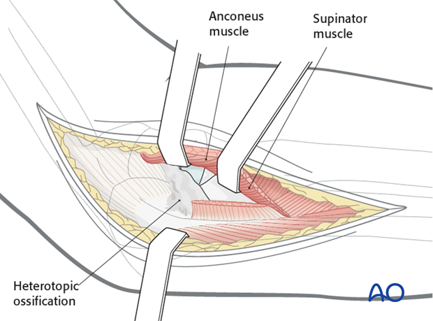 heterotopic ossification