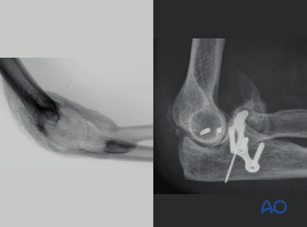 heterotopic ossification