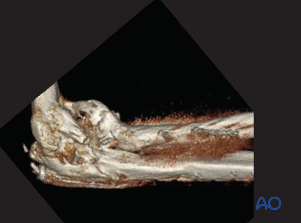 heterotopic ossification