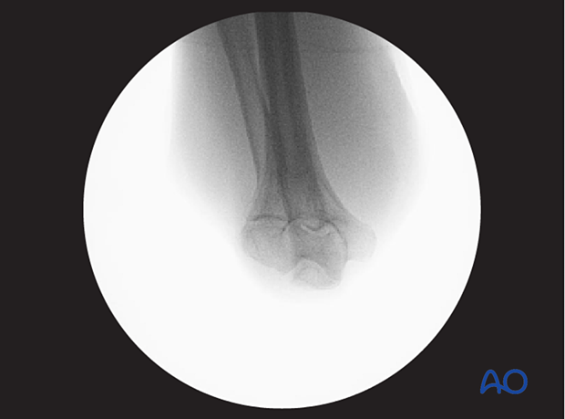 Optimal axial view