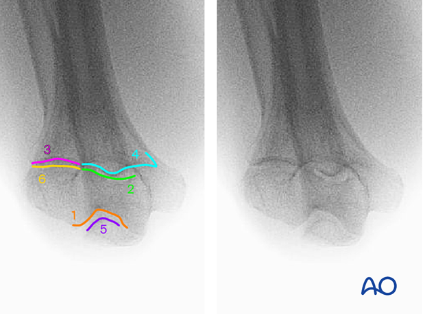 Anatomical lines and landmarks in the axial view