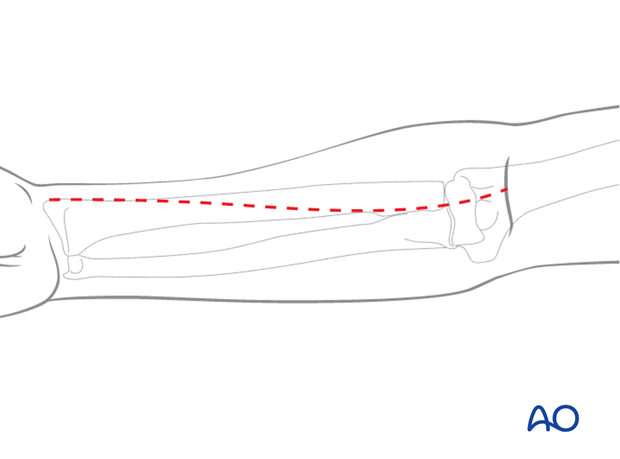 Anterior approach henry 