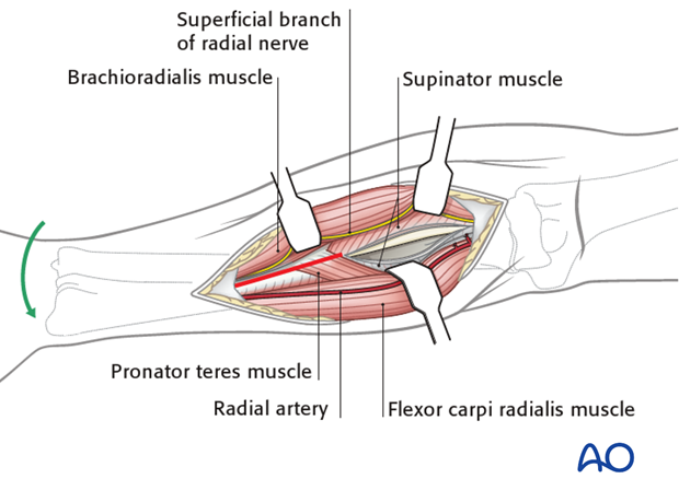 Anterior approach henry 