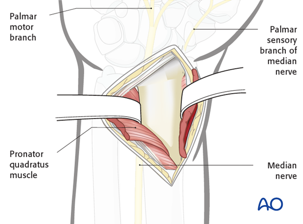 Anterior approach henry 