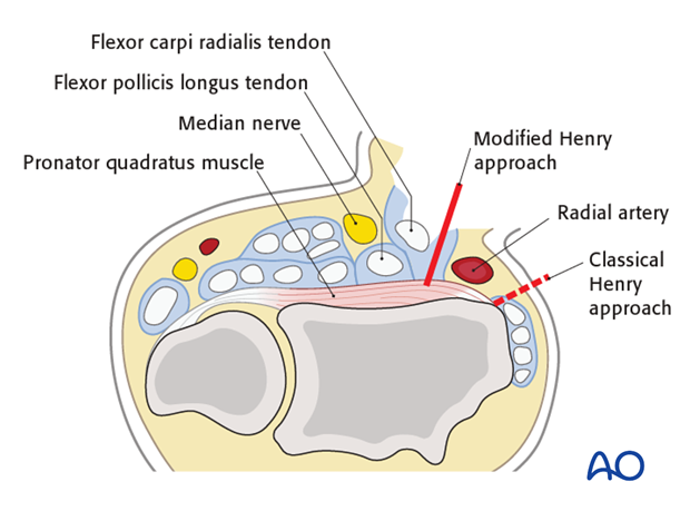 Anterior approach henry 