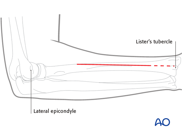 Posterolateral approach (Thompson)