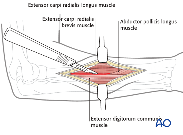 Posterolateral approach (Thompson)