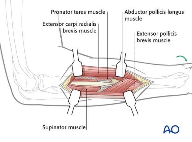 Posterolateral approach (Thompson)