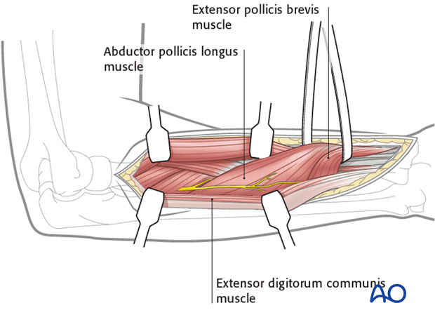 Posterolateral approach (Thompson)