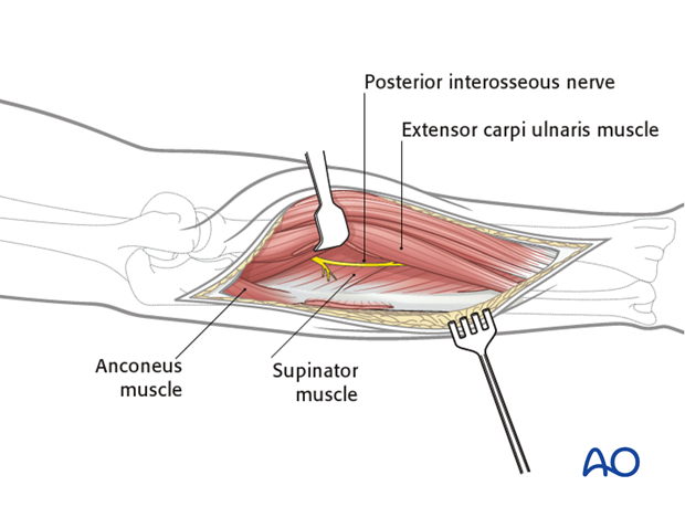 Combined posterior approach to radius and ulna