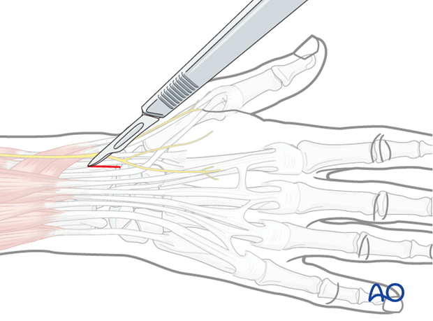 Approaches to the radius for intramedullary nailing