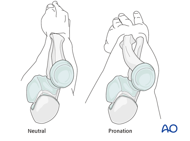 Safe zones for pin placement in the forearm