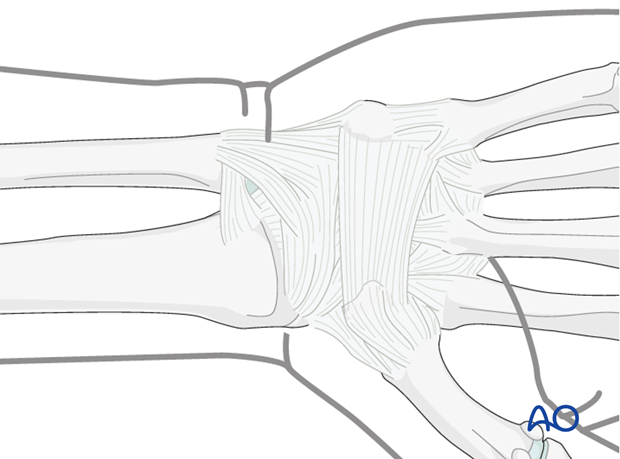 Approaches to the DRUJ (posterior/anterior)