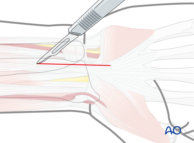 Approaches to the DRUJ (posterior/anterior)