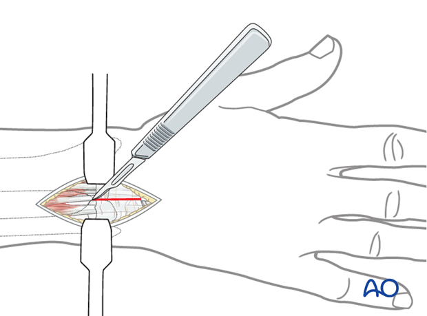 Approaches to the DRUJ (posterior/anterior)