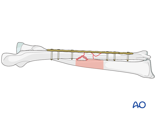 Choice of implant