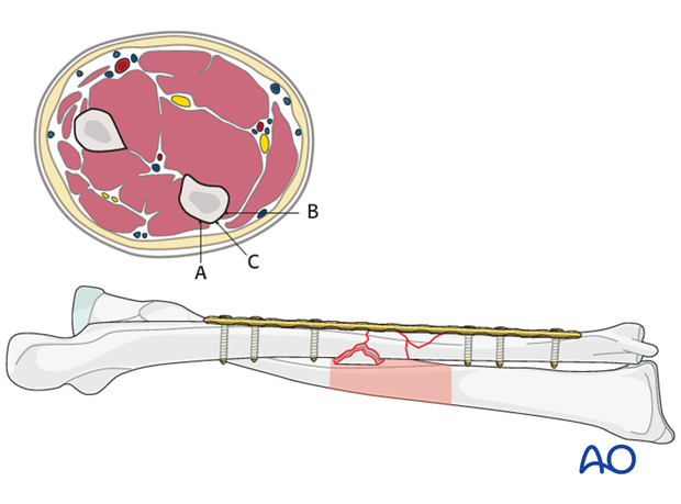 Plate position on ulna