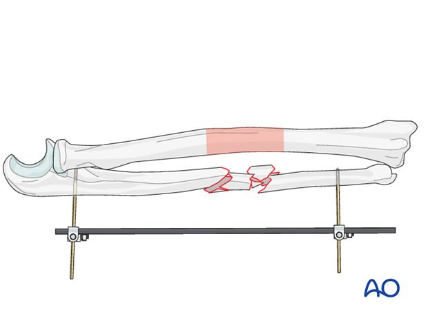 Temporary external fixator or small disctractor