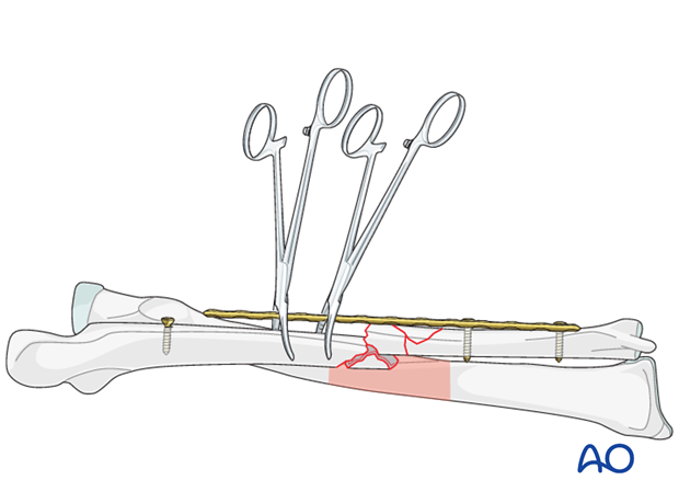 Second forceps