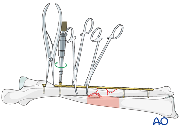 Preliminary fixation of the ulnar plate (after push-pull technique)