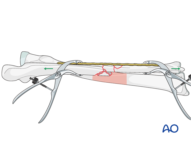 Manual traction and applying clamps onto the main fracture fragments with the aid of a plate