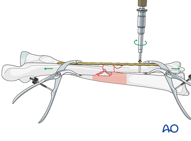 Preliminary fixation of the ulnar plate